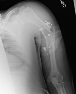 x-ray of humurus pre surgery